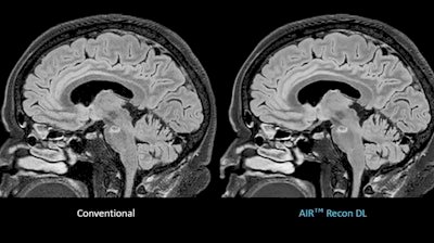 GE HealthCare Expands Effortless Recon DL Portfolio, Revolutionizing Imaging with Deep Learning-Powered Reconstruction